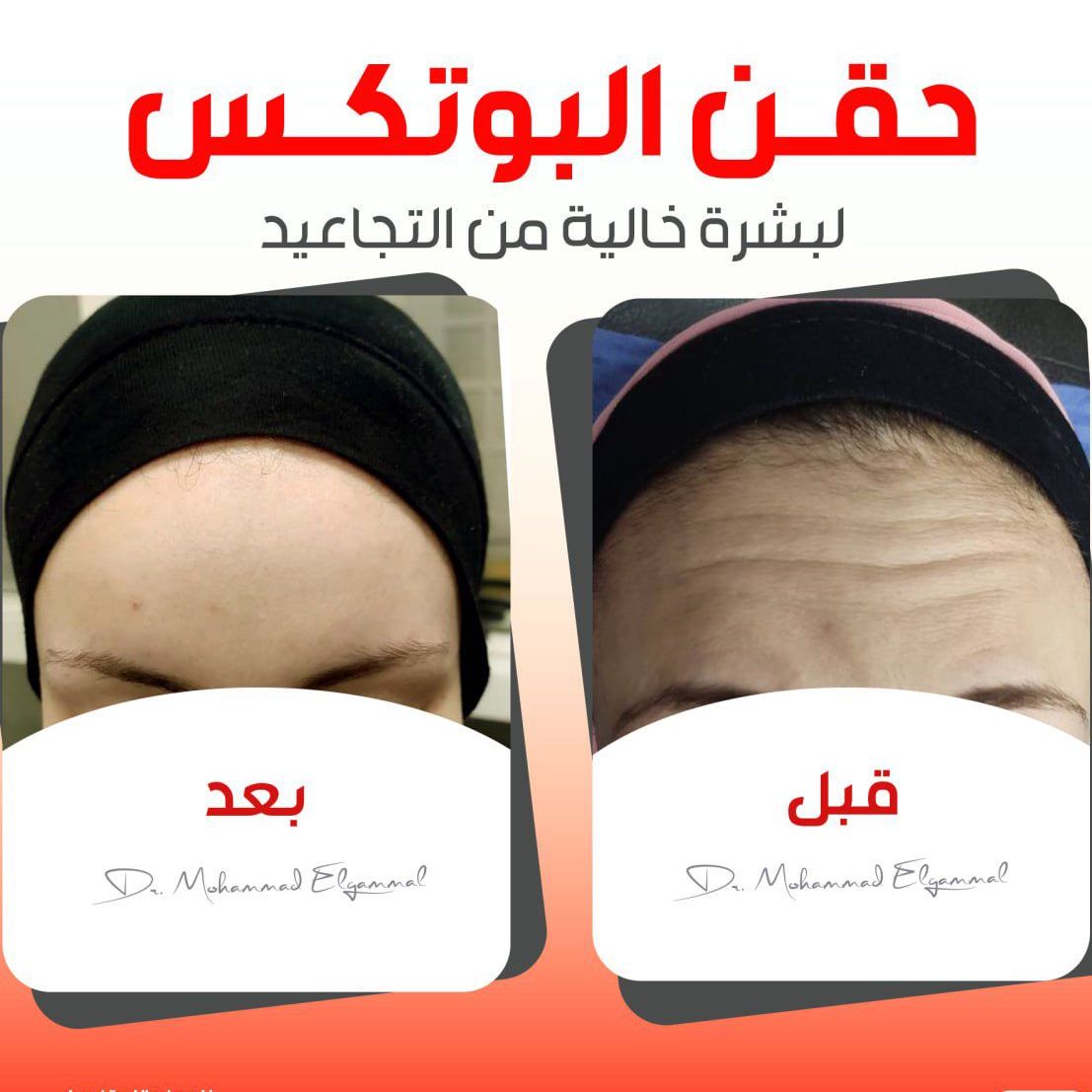 البوتوكس