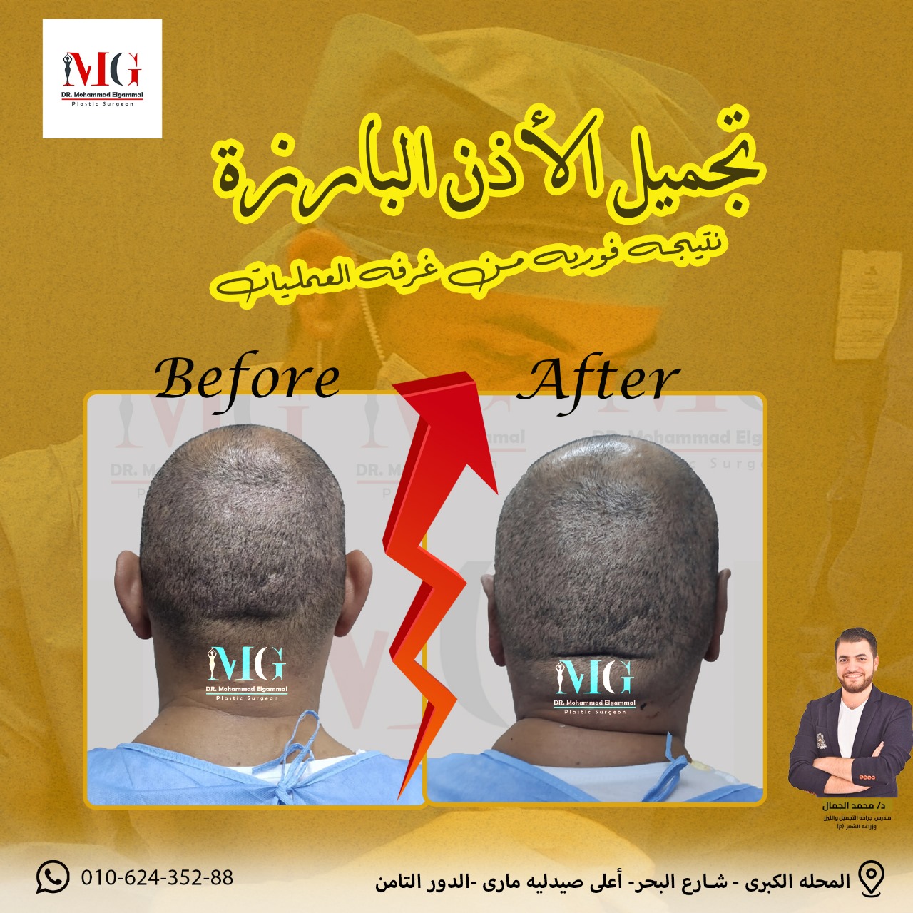 تصغير الأذن