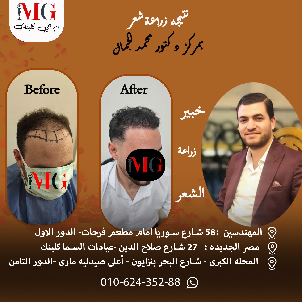 زراعة شعر ٤