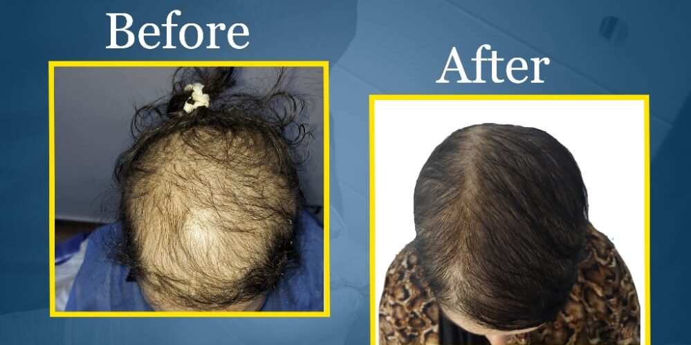 نتيجة زراعة شعر — خط الشعر الأمامي