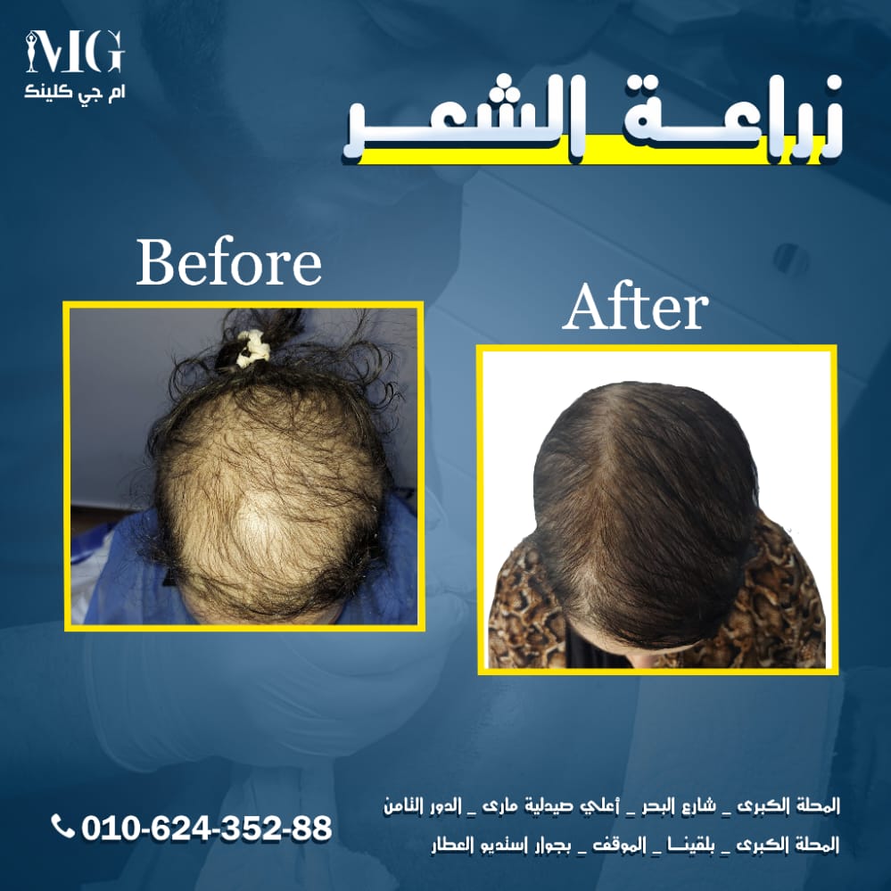 نتيجة زراعة شعر — كثافة واضحة