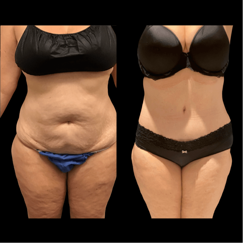 نتيجة شفط الدهون — تجميل الأمهات